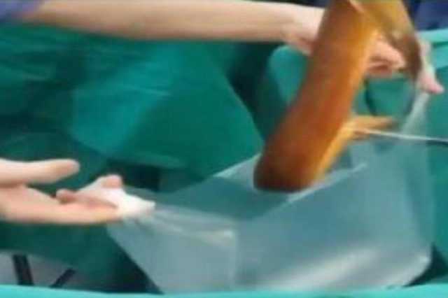 1524425 jegulja iz stomaka ls